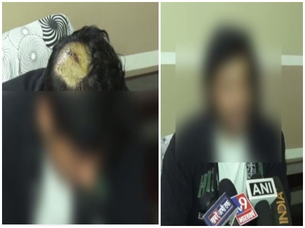 The man sustained six stitches on head. (Photo/ANI)