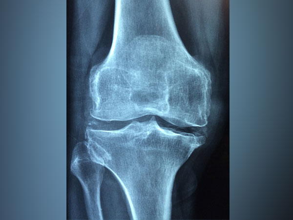 According to study experts, one of the greatest challenges with treating osteoarthritis and subsequent joint damage is repairing the damaged tissue.