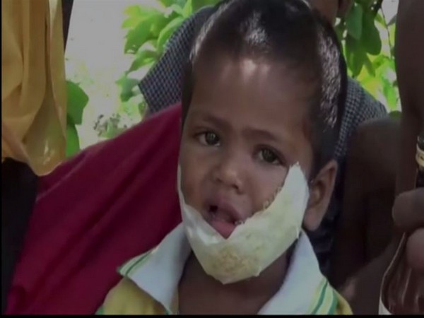 3-year-old Gujan was bitten by a stray dog in the face on Monday in Jhajjar, Haryana.  [Photo/ANI][]