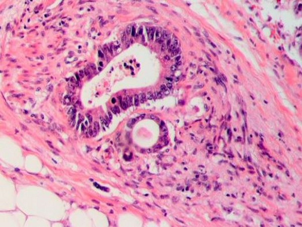 Tumor invasion into vein in a case of colorectal cancer.