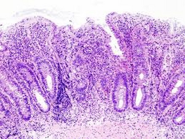 Ulcerative colitis