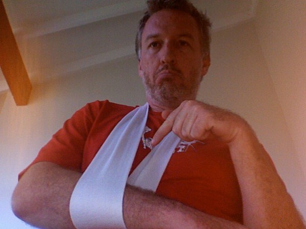 In the study, half of the patients were operated on, while the other half only had the arm supported by a sling.