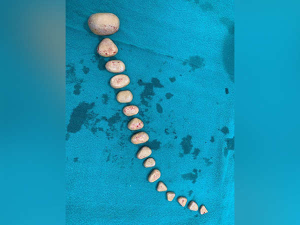 Visual of stones removed from man's urinary bladder (Photo/ANI)