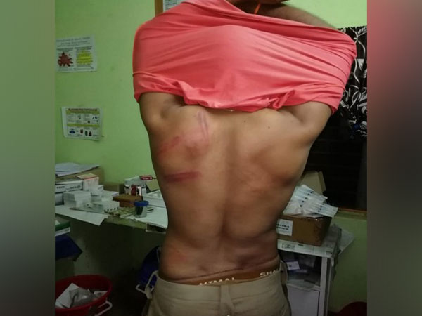 Visuals of visuals who suffered bruises.