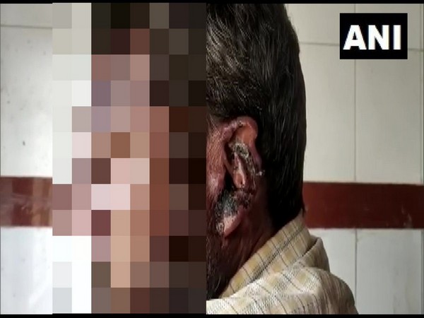 Shoaib Khan, the victim at district hospital in Khargone. Photo/ANI